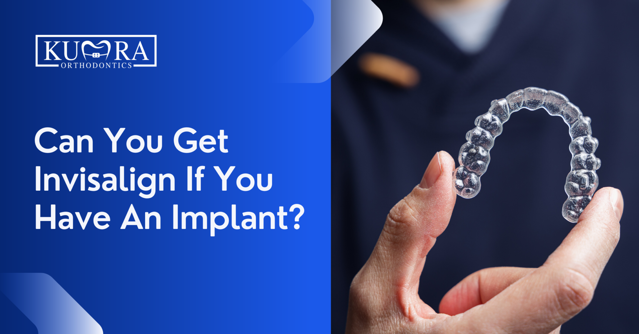 Can You Get Invisalign With An Implant Your Questions Answered Kumra