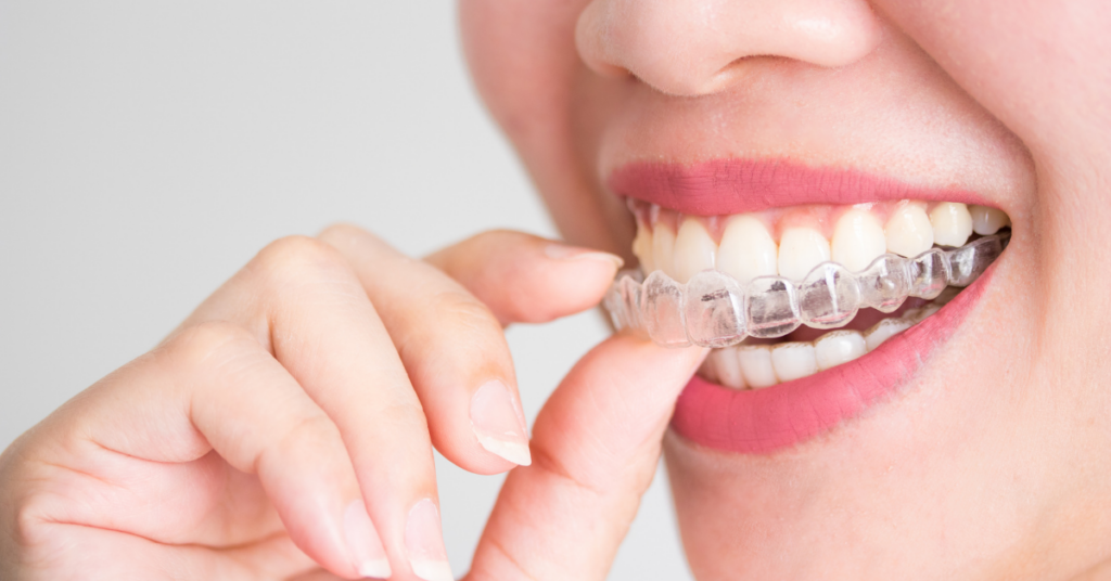 Benefits of Invisalign Compared to Getting Braces