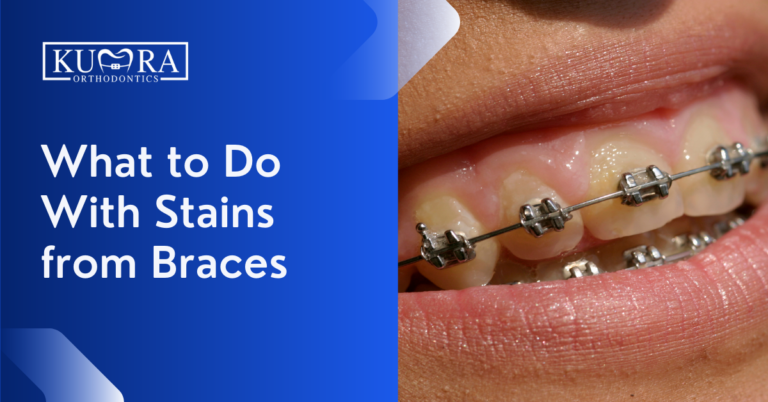 What To Do With Stains from Braces