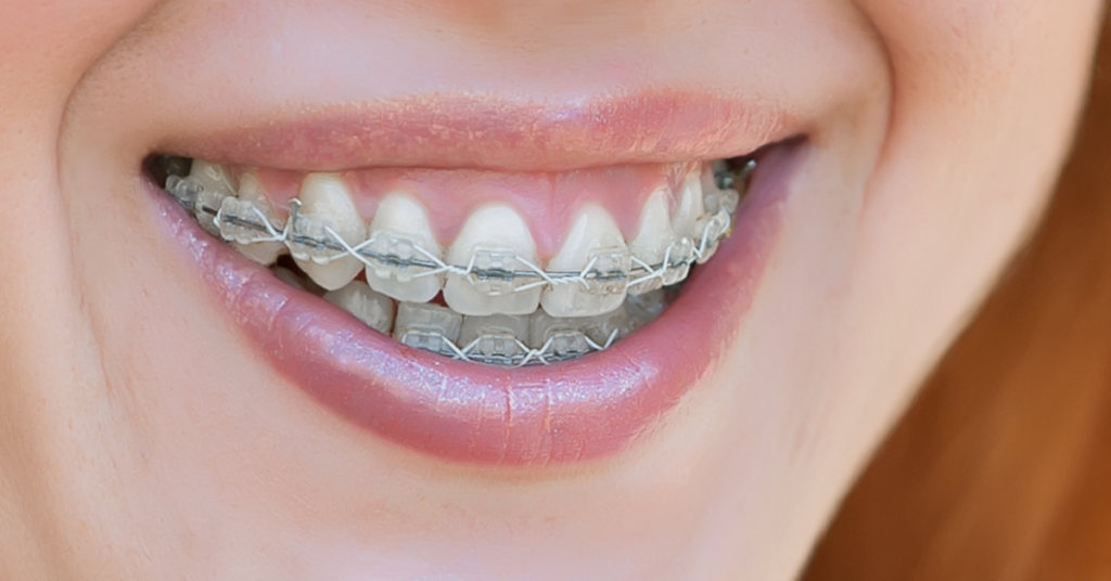 braces on adults - kumra ortho