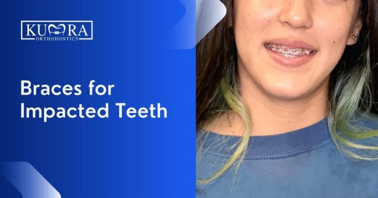 Braces for Impacted Teeth