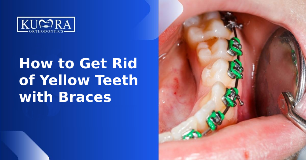 How to Get Rid of Yellow Teeth with Braces Kumra Orthodontics
