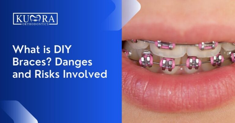 What are DIY Braces? Dangers and Risks Involved