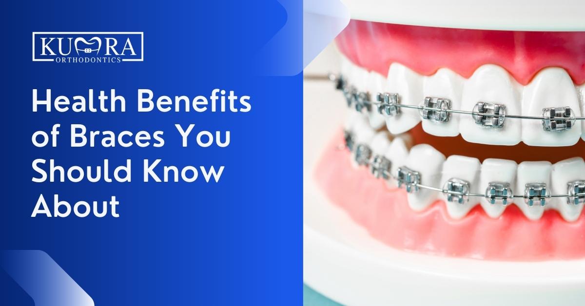 What are the Health Benefits of Braces?