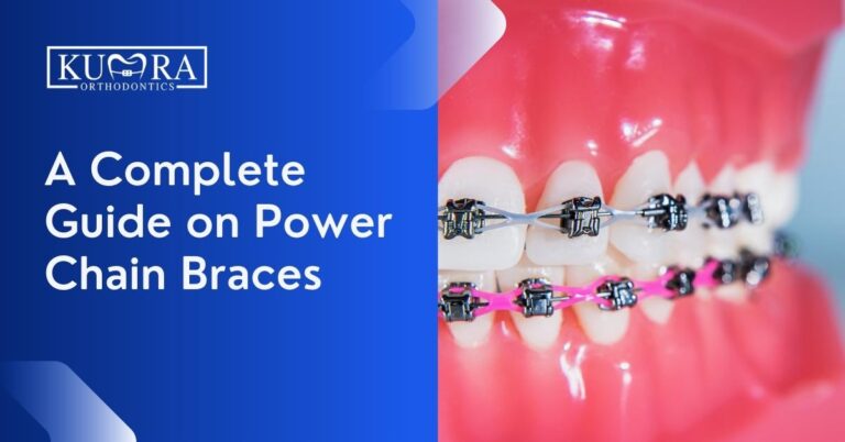 A Complete Guide on Power Chain Braces