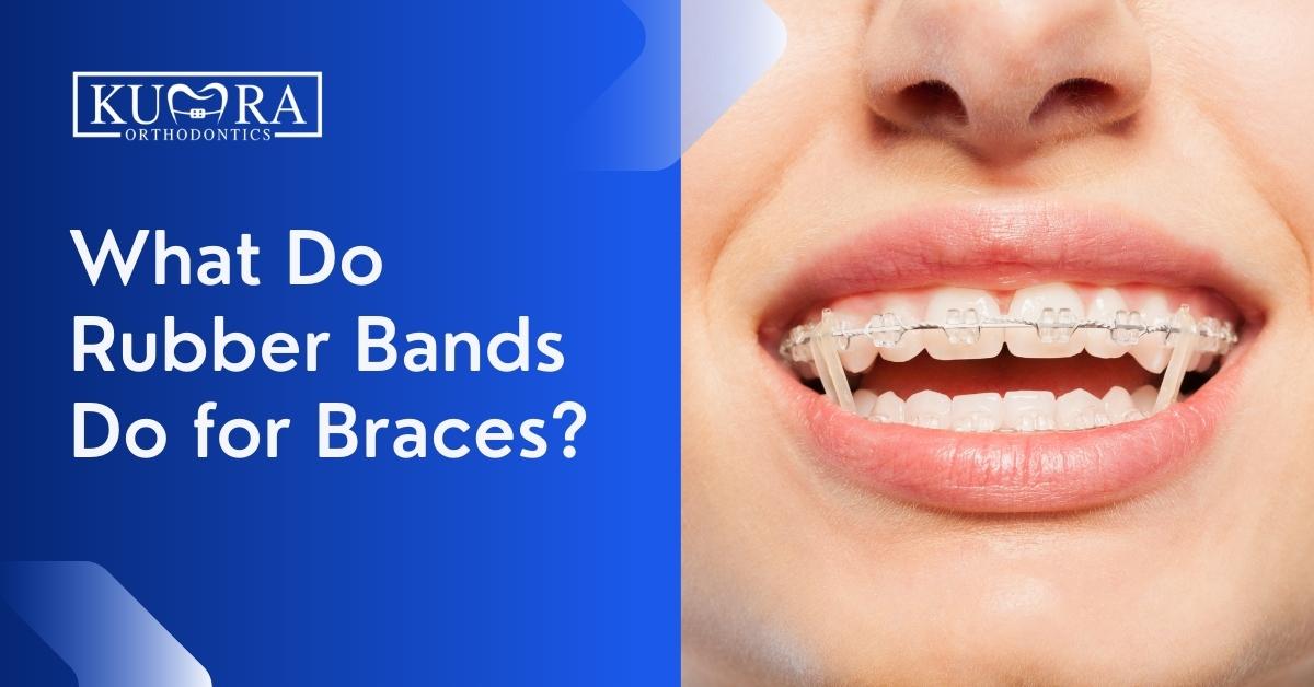 What-Do-Rubber-Bands-Do-for-Braces