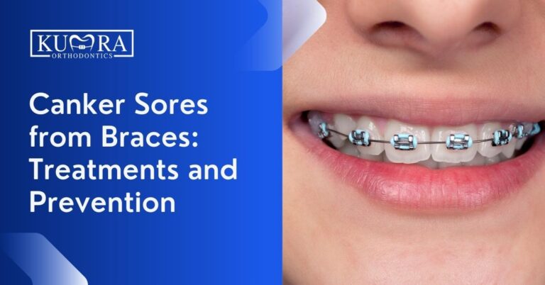 Canker Sores from Braces: Treatments and Prevention