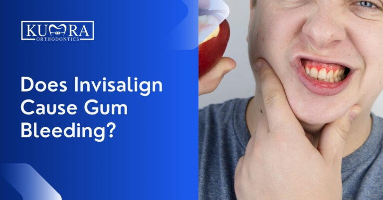 Does-Invisalign-Cause-Gum-Bleeding_