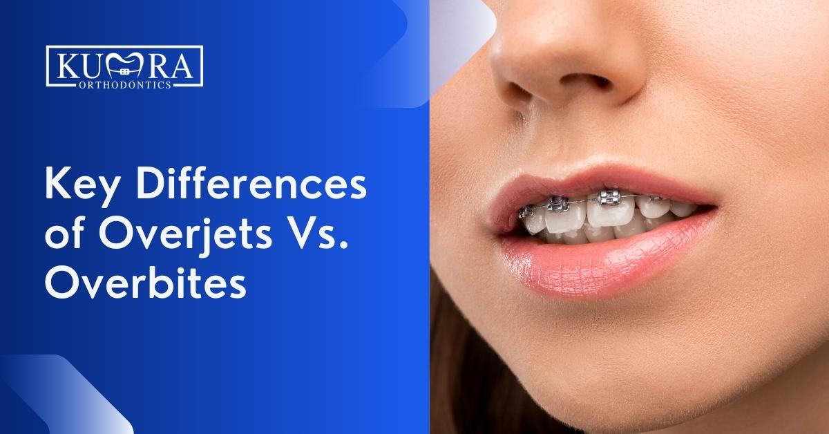 What Is the Difference between an Overbite and an Overjet?