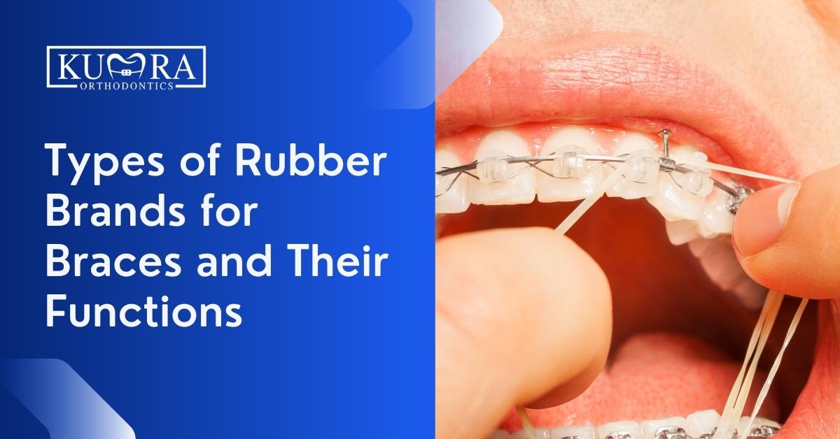 What Do Tthe Rubber Bands Do For Braces