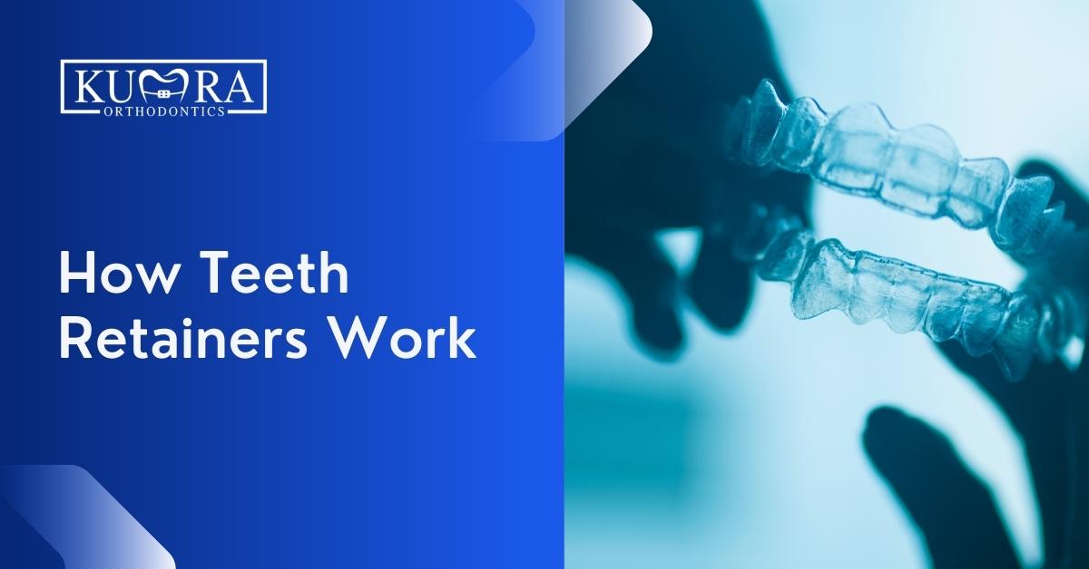 How-Teeth-Retainers-Work