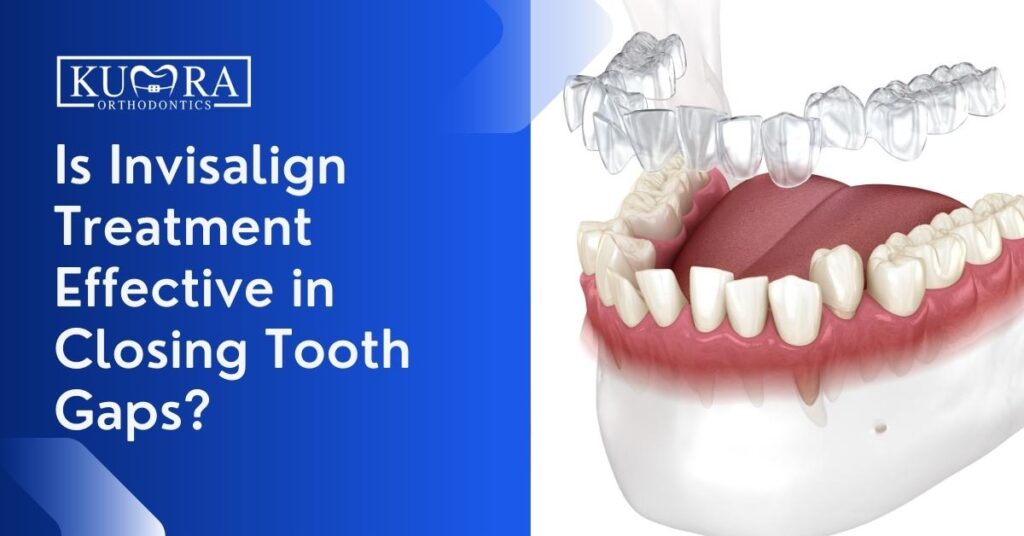 Is Invisalign Treatment Effective In Closing Tooth Gaps  1024x536 