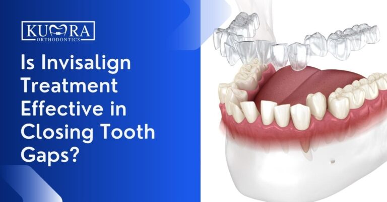Is Invisalign Treatment Effective in Closing Tooth Gaps?