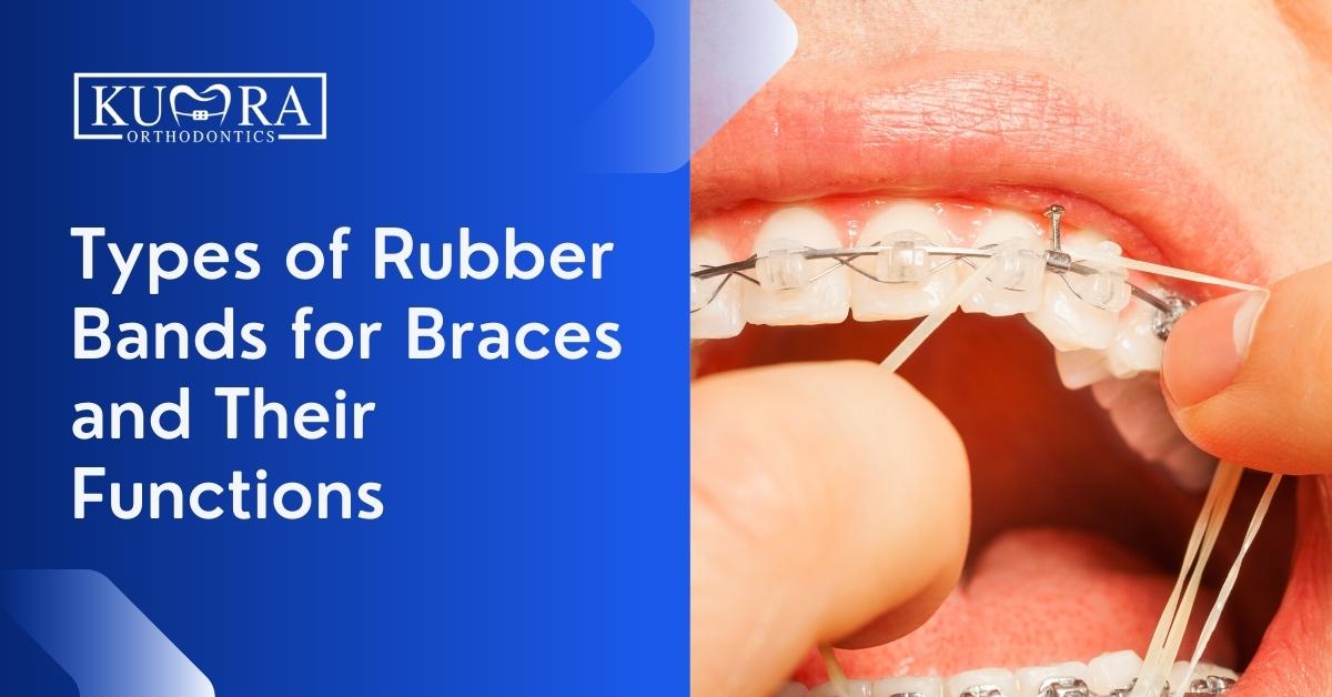 Types of Rubber Brands for Braces and Their Functions Kumra Orthodontics