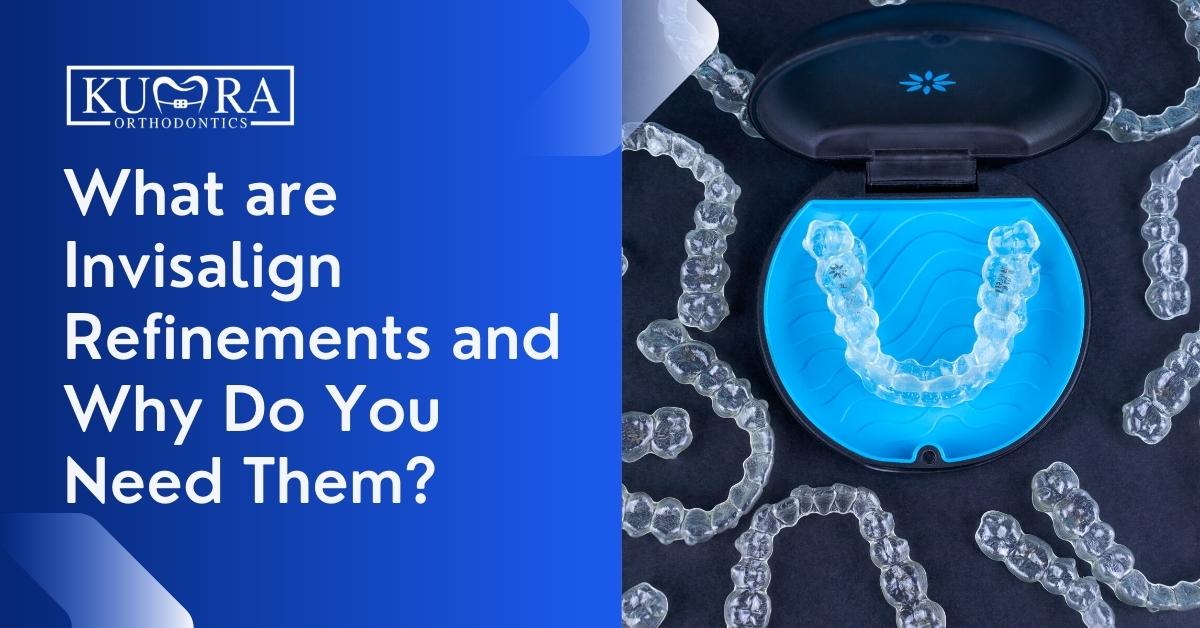 What-are-Invisalign-Refinements-and-Why-Do-You-Need-Them