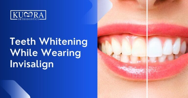 Teeth Whitening While Wearing Invisalign