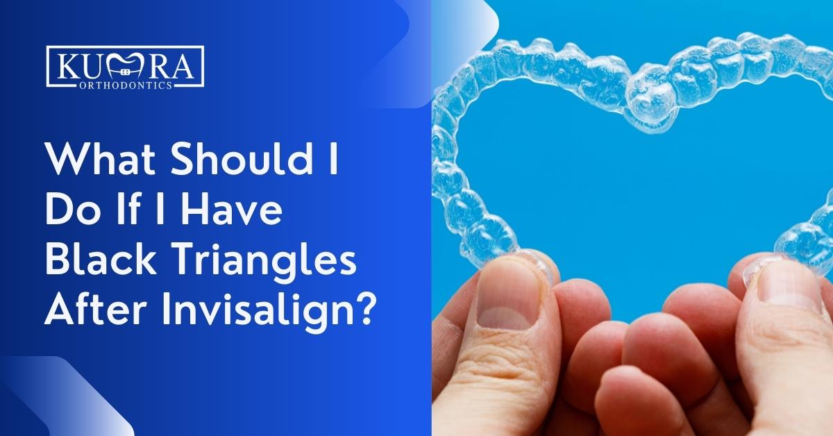 What-Should-I-Do-If-I-Have-Black-Triangles-After-Invisalign