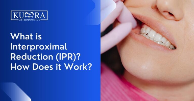 What is Interproximal Reduction (IPR)? How Does it Work?