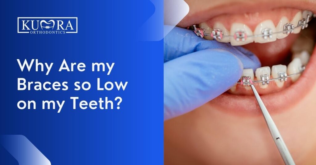 Why Are My Braces so Low on My Teeth?
