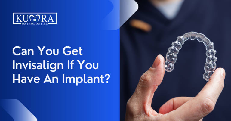 Can You Get Invisalign With An Implant? Your Questions Answered