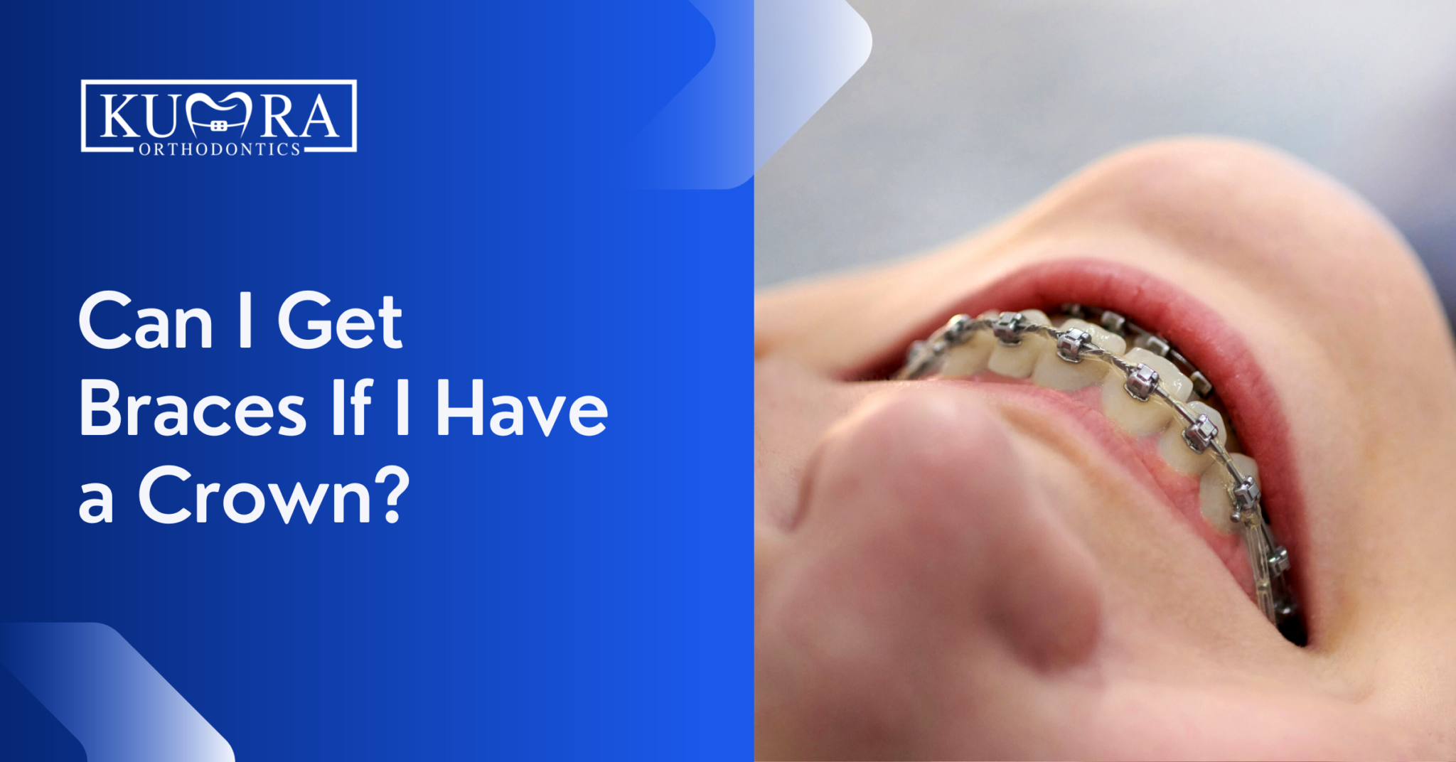 Can You Get Braces with a Crown? Things to Know Kumra Orthodontics