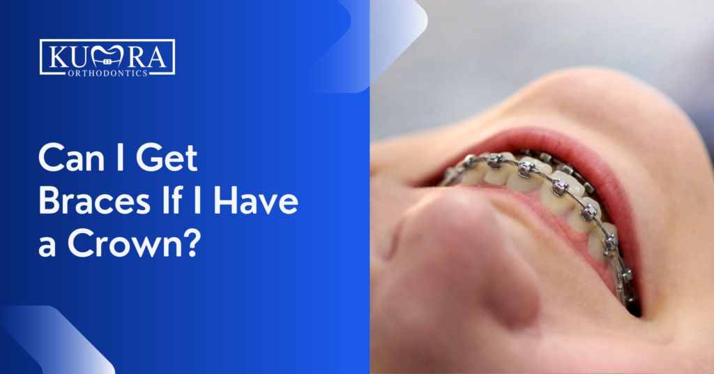 Can You Get Braces with a Crown? Things to Know