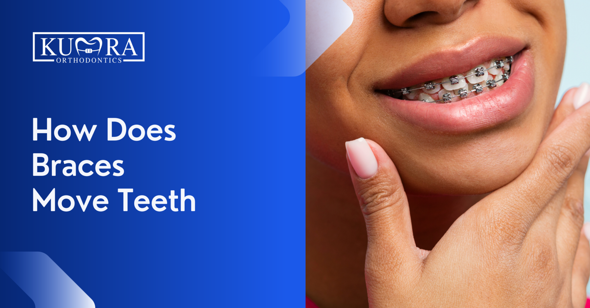 The Science of How Braces Move Your Teeth Kumra Orthodontics