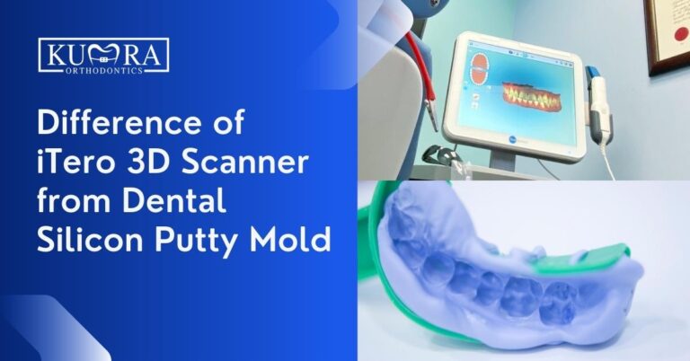 Difference of iTero 3D Scanner from Dental Silicon Putty Mold