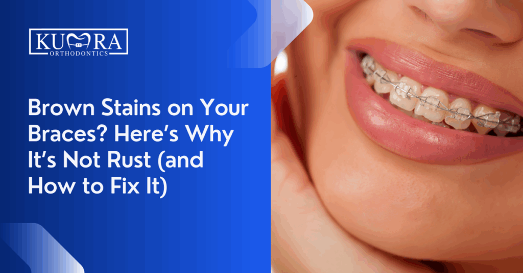 Brown Stains on Your Braces? Here’s Why It’s Not Rust (and How to Fix It)