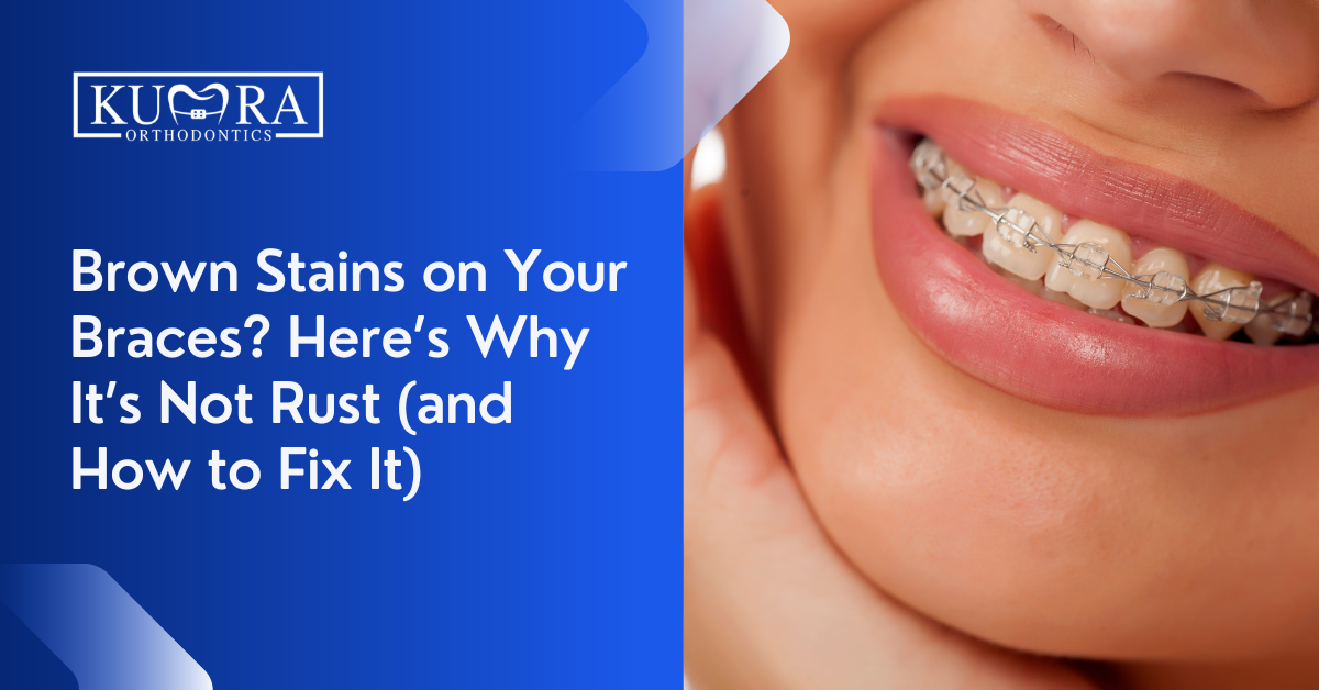 Brown Stains on Your Braces? Here’s Why It’s Not Rust (and How to Fix It)