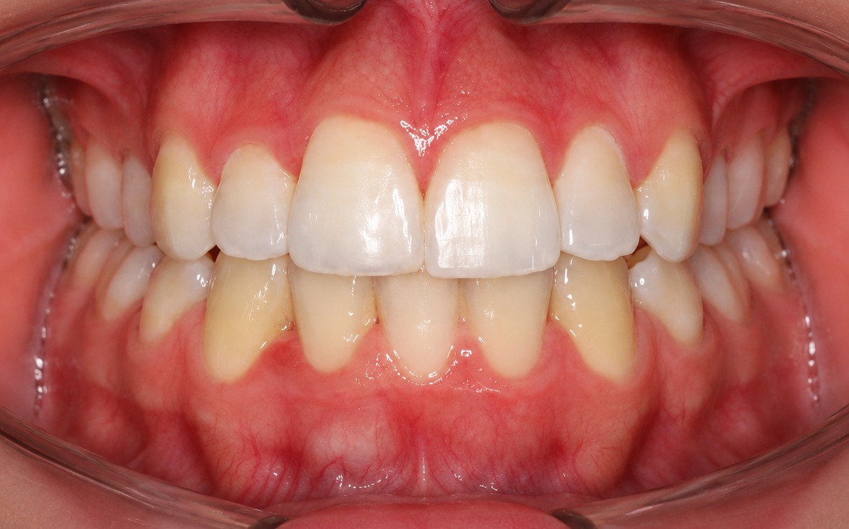 Teeth After 2