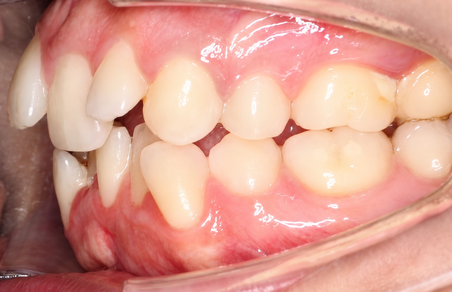 Teeth Before 3 Teeth Before 3